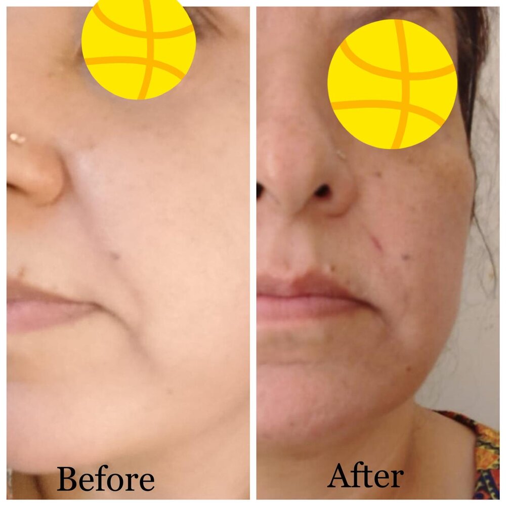 Facial Skin Rejuvenation before and after at Skin Innovations