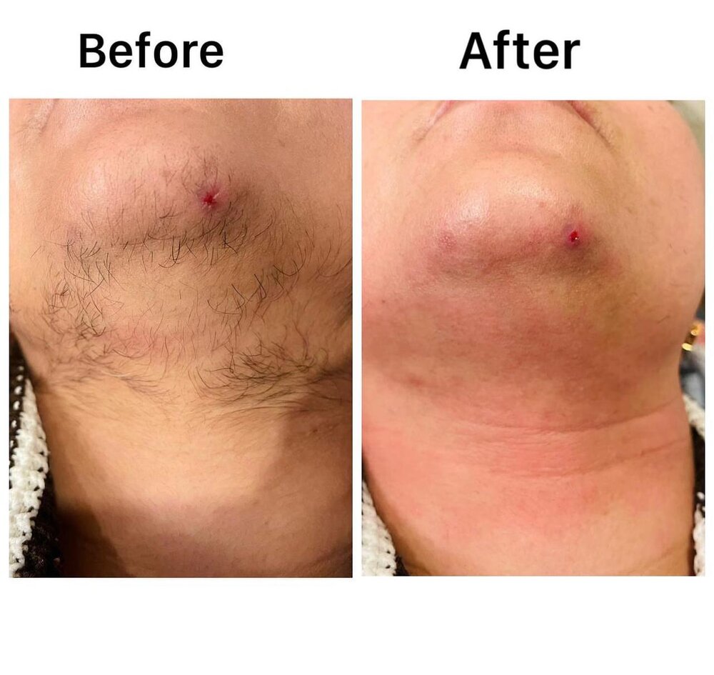 Laser Hair Removal before and after at Skin Innovations