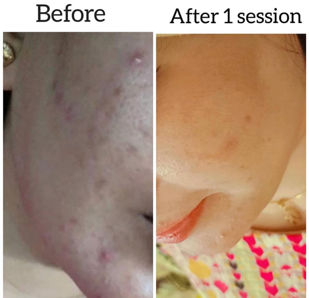 Microneedling for Acne Marks before and after at Skin Innovations
