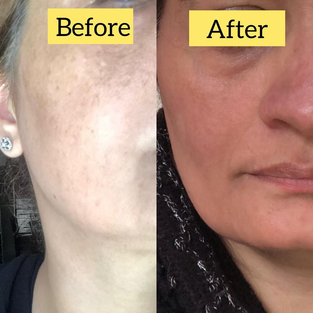 Chemical Peel for Pigmentation before and after at Skin Innovations