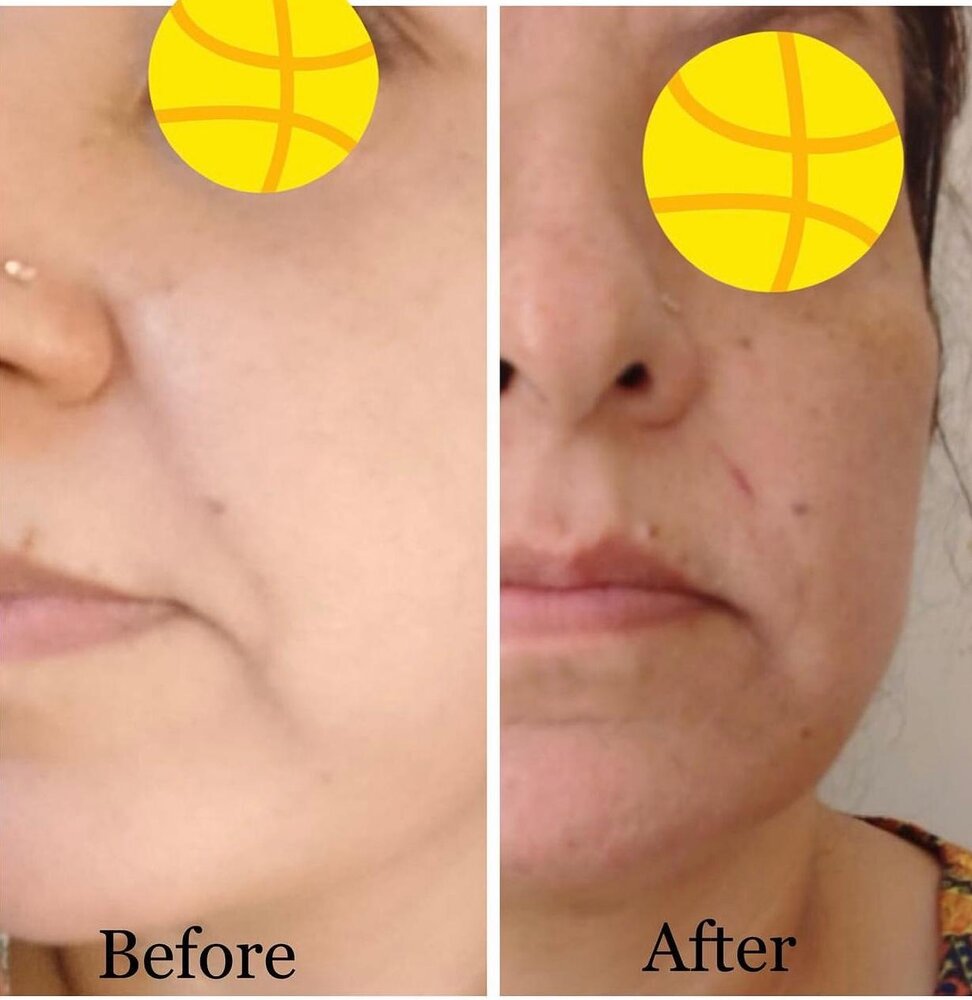 Skin Texture Improvement before and after at Skin Innovations