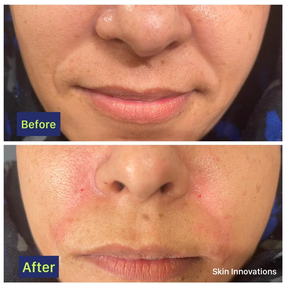PhotoFacial Glow before and after at Skin Innovations