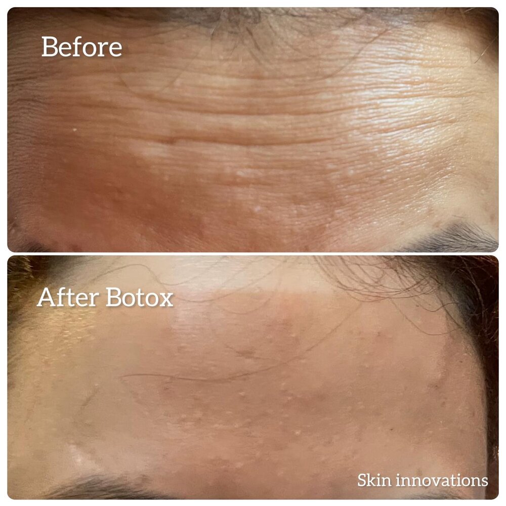 Botox for Forehead Lines before and after at Skin Innovations