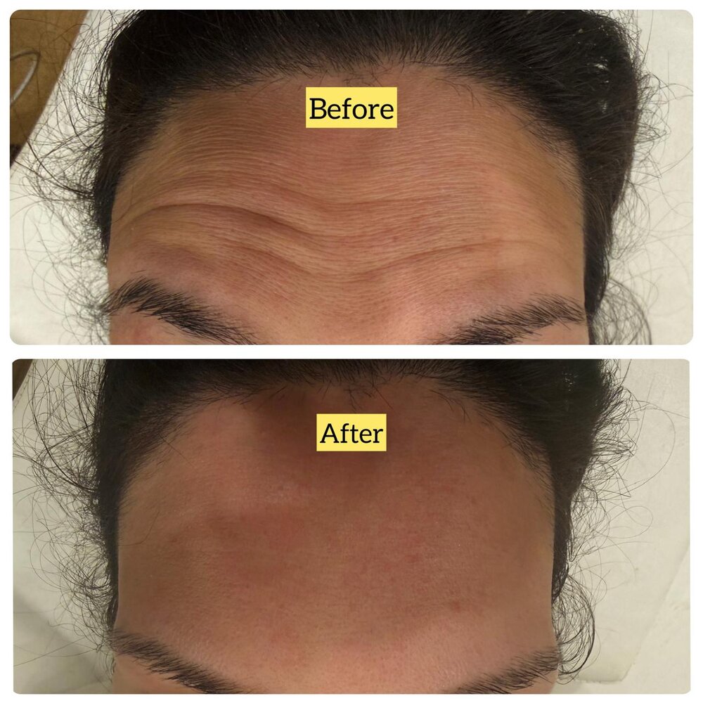 Botox for Frown Lines before and after at Skin Innovations
