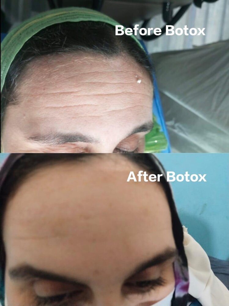 Botox Treatment before and after at Skin Innovations
