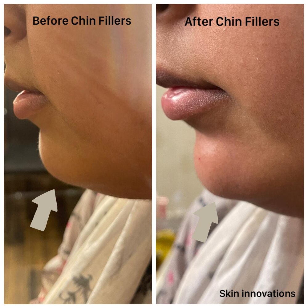 Chin Fillers before and after at Skin Innovations
