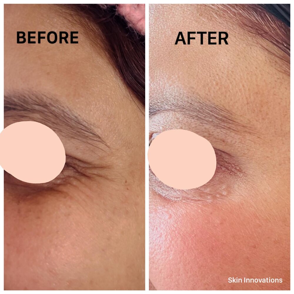 Under-Eye Rejuvenation before and after at Skin Innovations