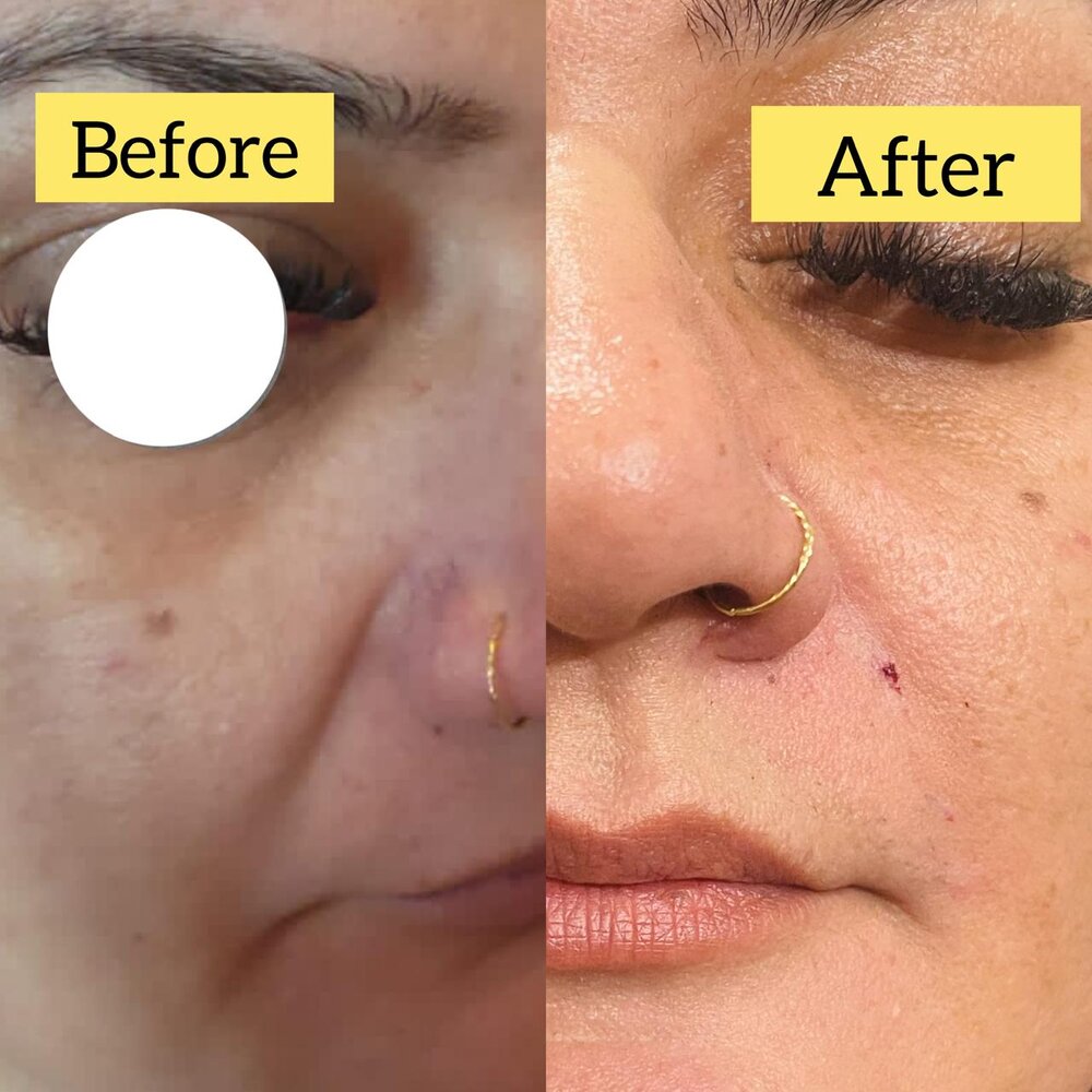 Skin Radiance Treatment before and after at Skin Innovations